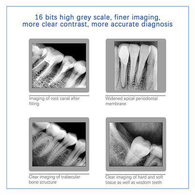 Dental X-Ray Digital Sensor Untuk Implan Gigi Dan Pengobatan Endodontik